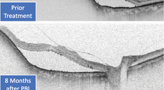 SS OCT Presents Advances in Ocular Tumor Treatment