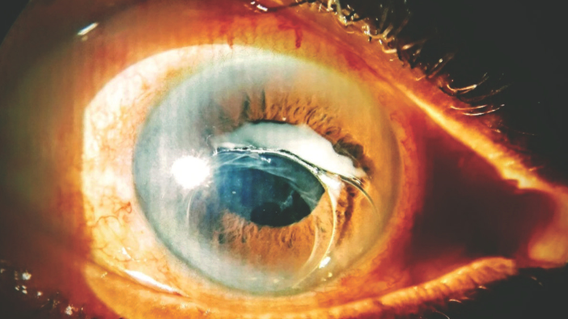 Late Spontaneous Dislocation of the IOLCapsular Bag Complex in a Patient With Retinitis Pigmentosa