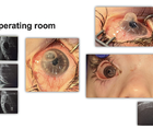A Unique Case of Moraxella Keratitis in Moebius Syndrome