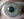 Figure 3. PHSD appears as an annular, peripheral, subepithelial, mildly raised, translucent opacity, often with areas of fine peripheral vascularization.