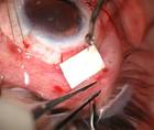 Tube Shunt Implantation Following Keratolimbal Graft thumbnail