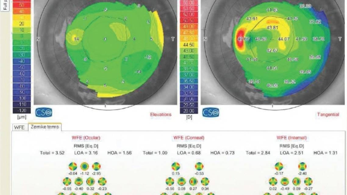 Monocular Diplopia Foggy Vision and Uncomfortable Binocular Vision