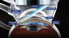 FLIGHT Femtosecond Laser Image Guided High Precision Trabeculotomy