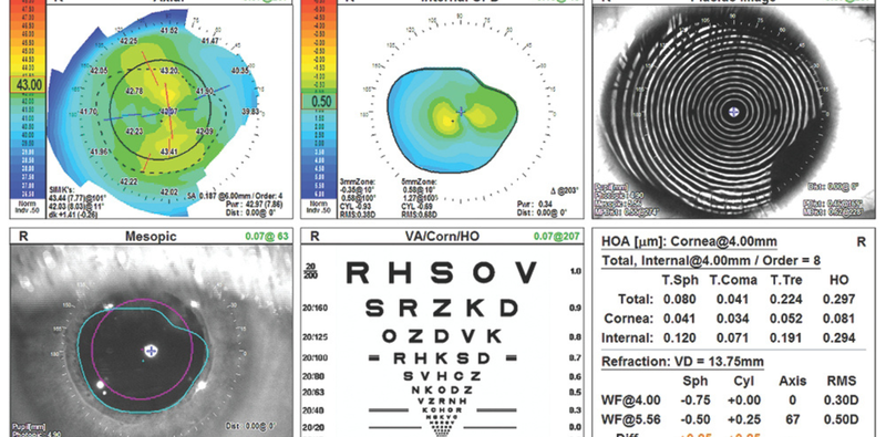 Cataract Management in a Young Adult With a Seizure Disorder