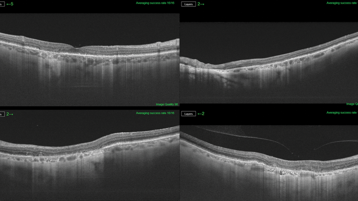 New Software Study GA AMD Quantification