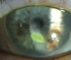 Expanding Options for Persistent Corneal Ulcer