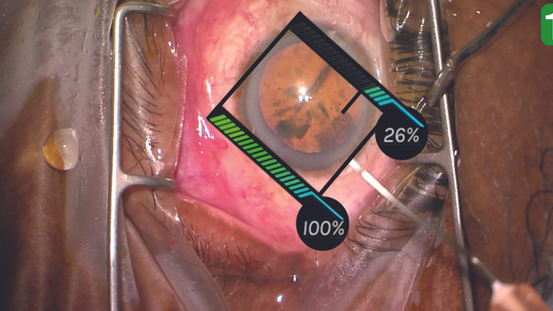 Clear Corneal Incisions