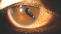 A Traumatically Dislocated but Perfectly Centered Multifocal IOL