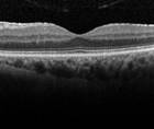 Evaluating the Retina Before Cataract Surgery