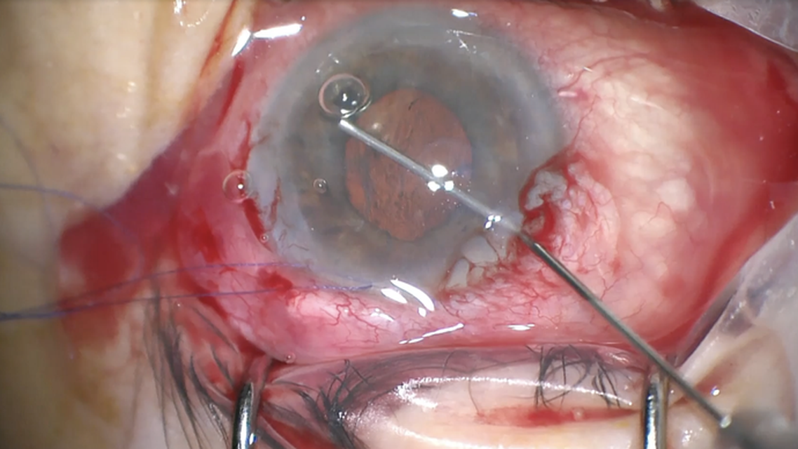 Sulcus Tube Shunt Synechialysis and IridoZonuloHyaloid Vitrectom thumbnail