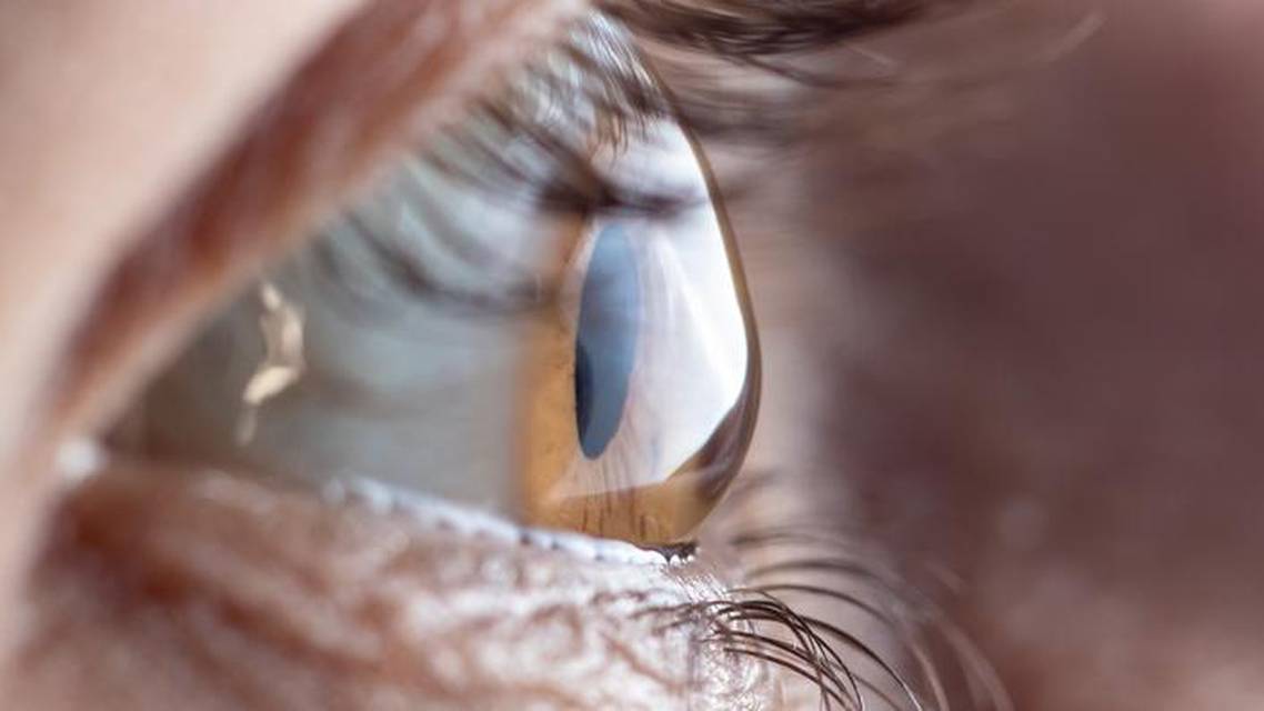 IOL Calculations for Patients With Keratoconus