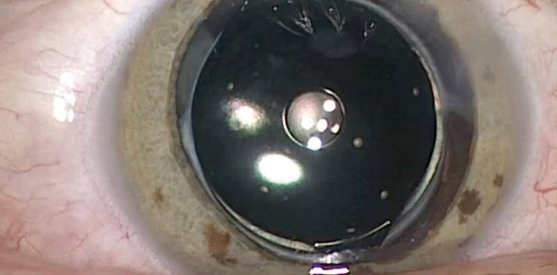 Off Label Use of Femtosecond Laser for Posterior Capsulotomy