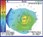 A Case of LACRIFILL Canalicular Gel Treatment in a Patient Following Refractive Cataract Surgery