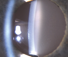 Calcification of Hydrophilic Acrylic IOLs