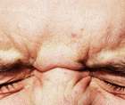 Managing the Unhappy Refractive Cataract Patient