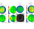 Visually Significant Cataract in the Presence of Corneal Disease