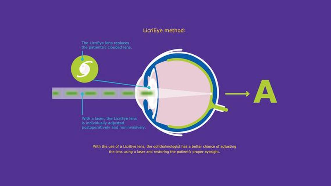 Making Room for Future IOL Technologies