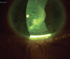 Neurotrophic Keratitis Post Retinal Detachment Surgery