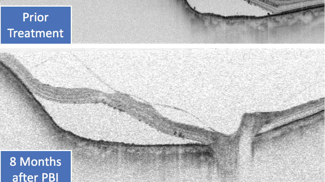 SS OCT Presents Advances in Ocular Tumor Treatment