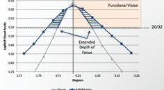 Myopia Why Refraction Matters