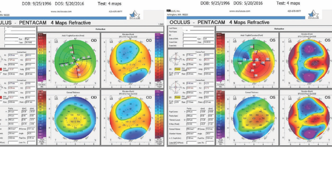 Legal Liability Issues in Keratoconus
