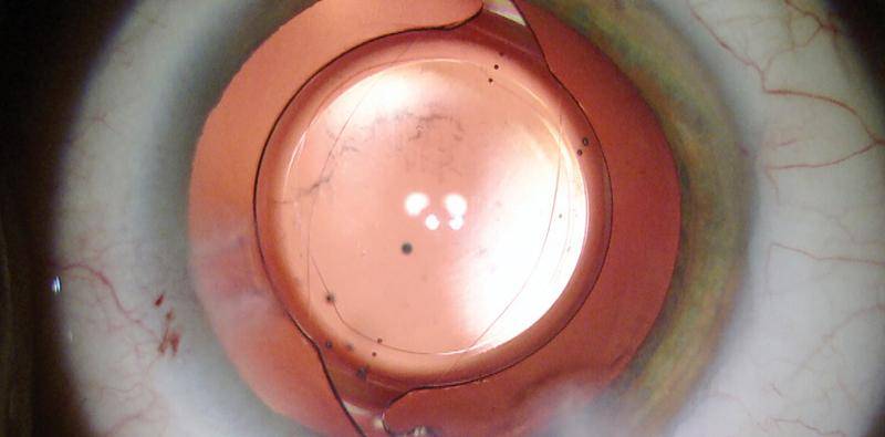 Indications for Posterior Capsulorhexis and Posterior Optic Capture