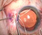 Management of Extensive Cyclodialysis Clefts thumbnail