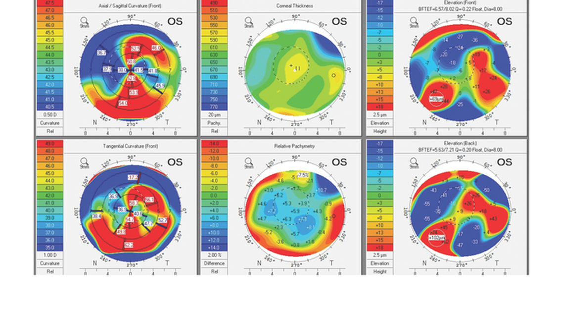 Multifocal Corneas