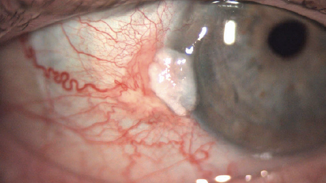 Chemotherapeutics in Eye Care Ocular Surface Squamous Neoplasia