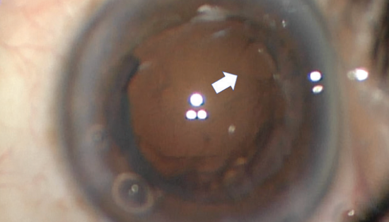 Anterior and Posterior Capsular Tears