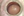 Figure 1. A clinical examination of the patient’s left eye showed inferior subluxation of the lens.