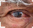 Chronic Inflammation After Cataract Surgery