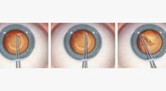Managing the Errant Capsulorhexis