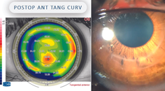 Therapeutic Refractive Surgery for Keratoconus