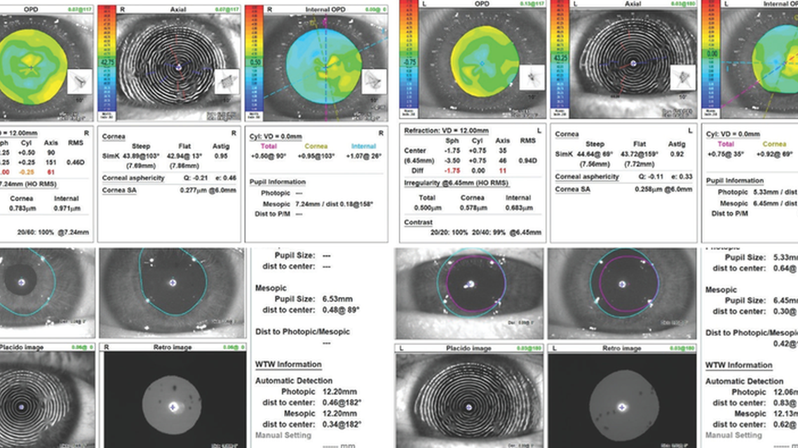Decreased Vision From Thygeson Superficial Punctate Keratitis