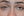 Figure 10. Postoperative appearance of the patient’s right eye. The left eye underwent no surgery.