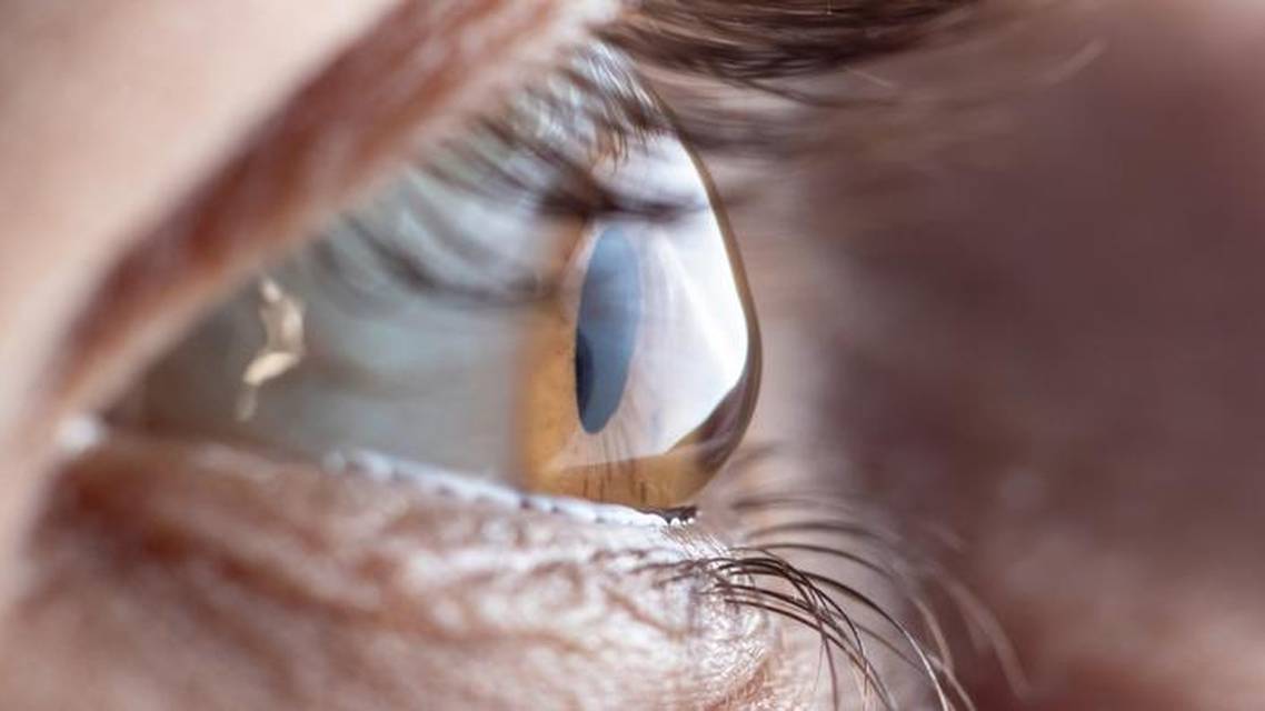 Pearls for Keratoconus Screening and Treatment