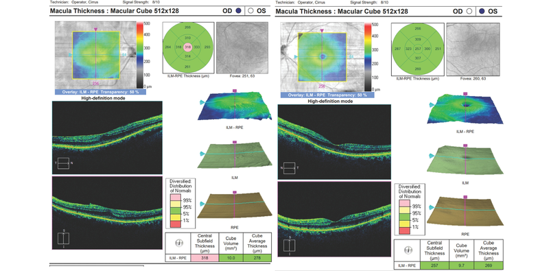 Epithelial Basement Membrane Dystrophy and Ocular Surface Disease