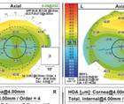 Is This the Perfect Candidate for Refractive Surgery