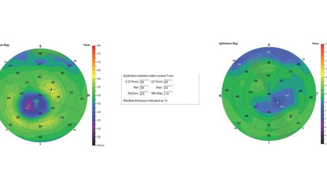 Epithelial Thickness Mapping for the Detection and Management of Corneal Irregularities