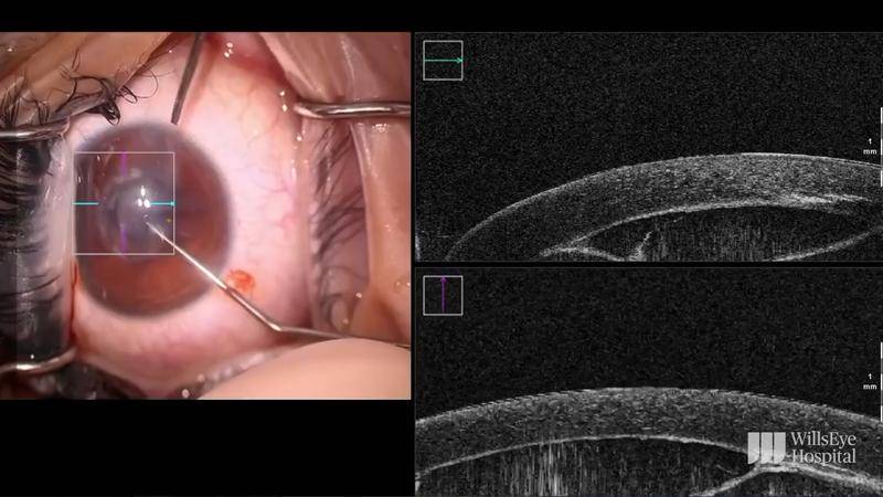 Intraoperative OCT for Corneal Cyst Removal thumbnail