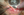 Figure 2. A limbal groove is created using a
crescent blade.