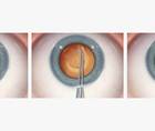 Managing the Errant Capsulorhexis
