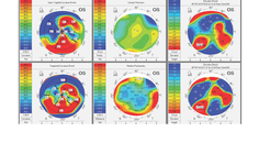 Multifocal Corneas