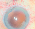 Traumatic Aphakia and Mydriasis