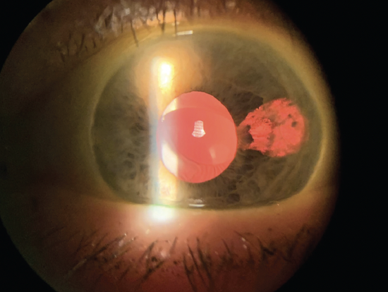 Defect In The Iris The Triad of Iris Prolapse
