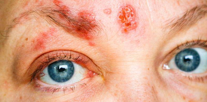 Update on the Zoster Eye Disease Study