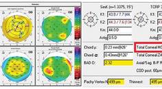 Improved Visual Outcomes With LACRIFILL Canalicular Gel Assisted Ocular Surface Optimization