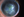 Figure 2. Follow-up visit showed improvement in epithelial healing with substantial corneal scarring.