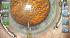 Optimizing the Incision